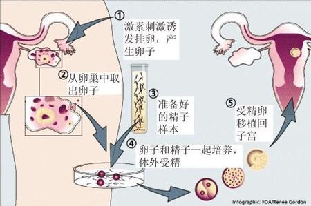 多囊卵巢案例